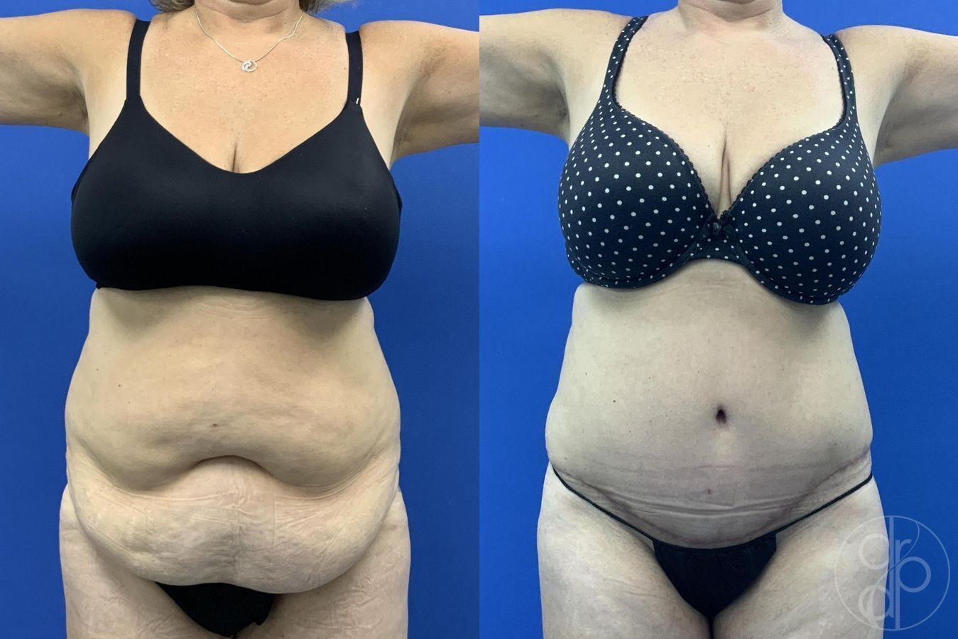 Before and after Abdominoplasty case 29619 - Angle 2