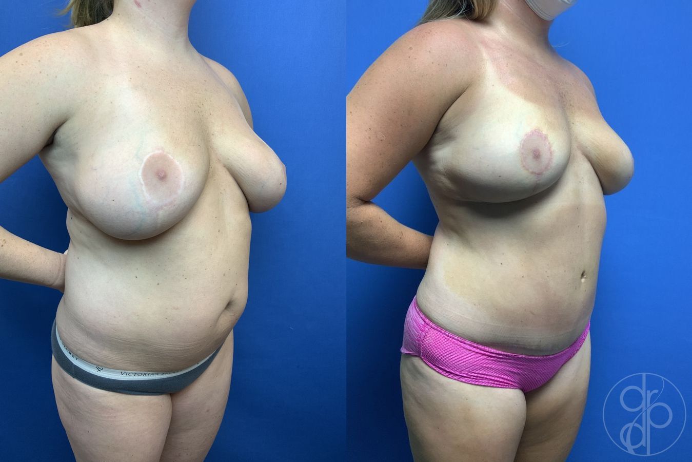 Before and after Abdominoplasty case 29691 - Angle 2