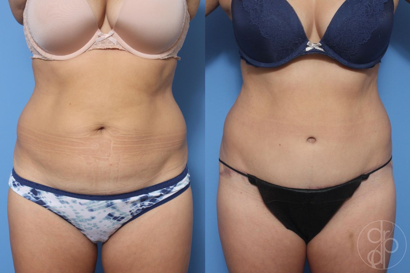 Before and after Abdominoplasty case 29523