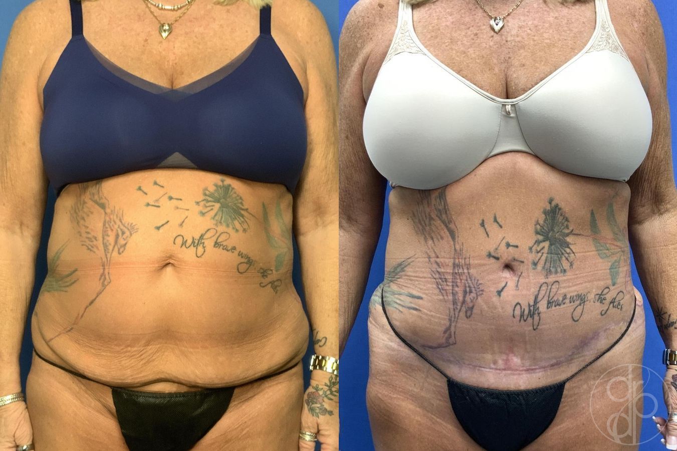 Before and after Abdominoplasty case 30022