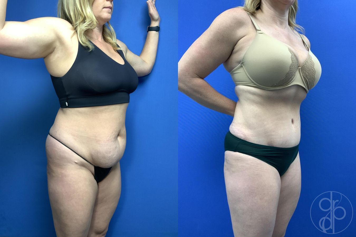 Before and after Abdominoplasty case 29762 - Angle 3