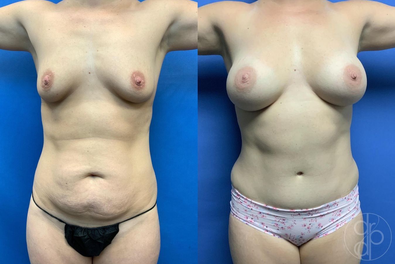 Before and after Abdominoplasty case 29698 - Angle 2