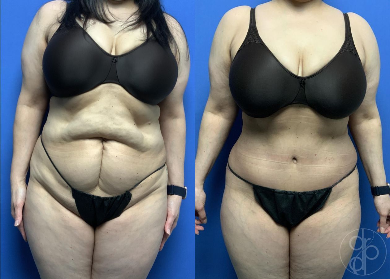 Before and after Abdominoplasty case 29569
