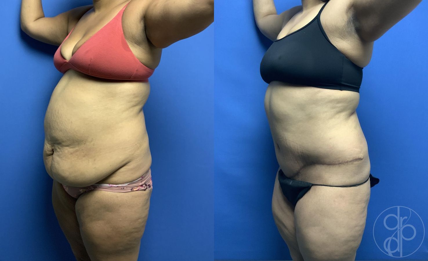 Before and after Abdominoplasty case 29566 - Angle 3