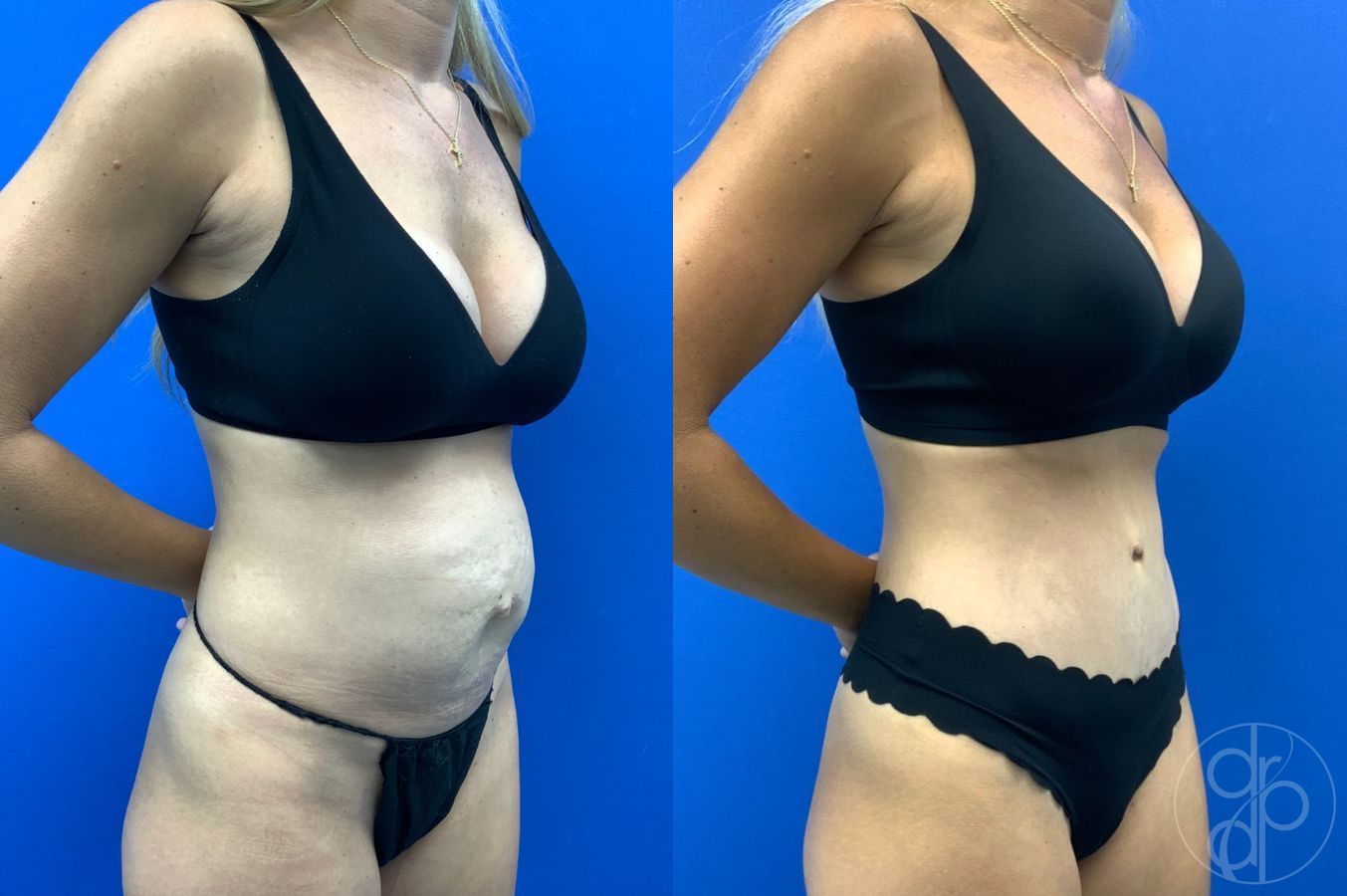 Before and after Abdominoplasty case 49485 - Angle 5