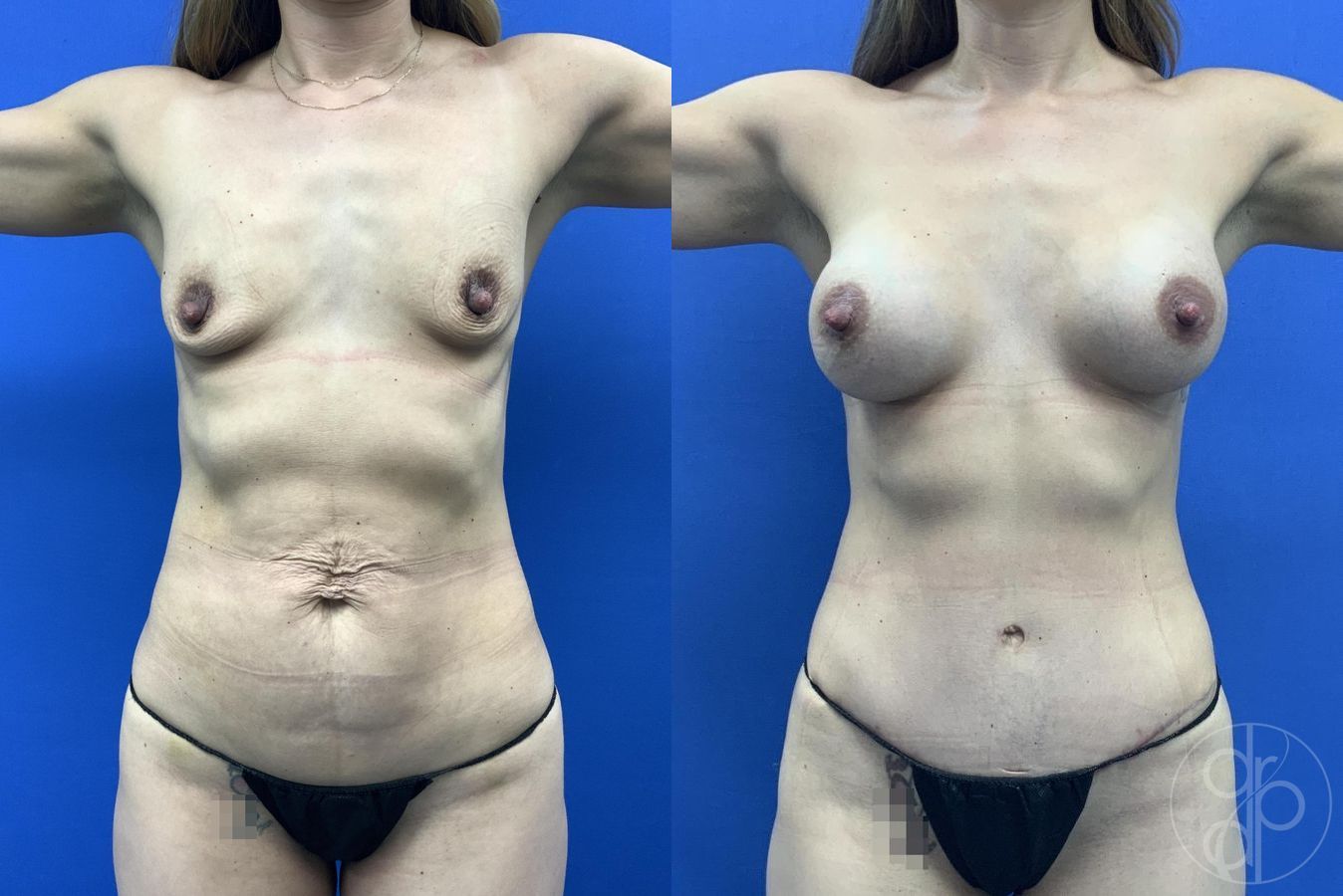 Before and after Abdominoplasty case 29642 - Angle 2