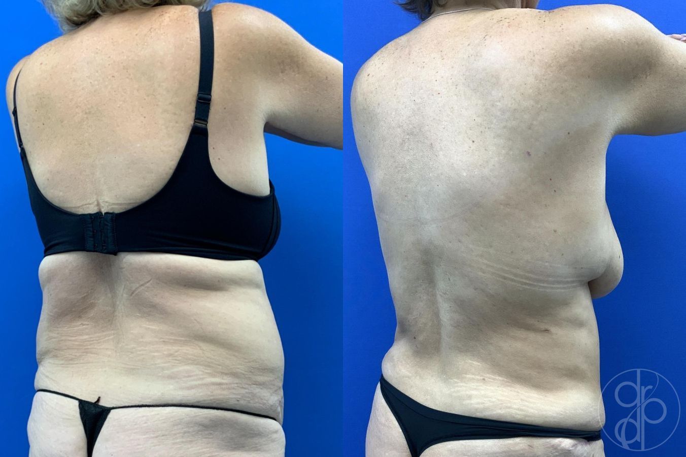 Before and after Abdominoplasty case 29619 - Angle 6