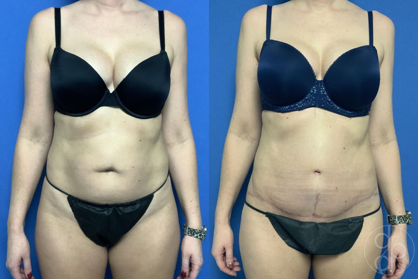 Before and after Abdominoplasty case 29573