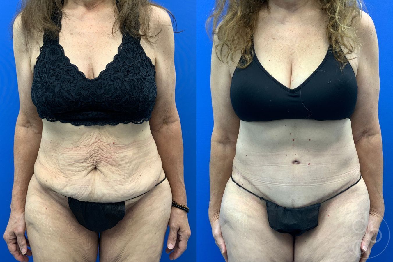Before and after Abdominoplasty case 43198