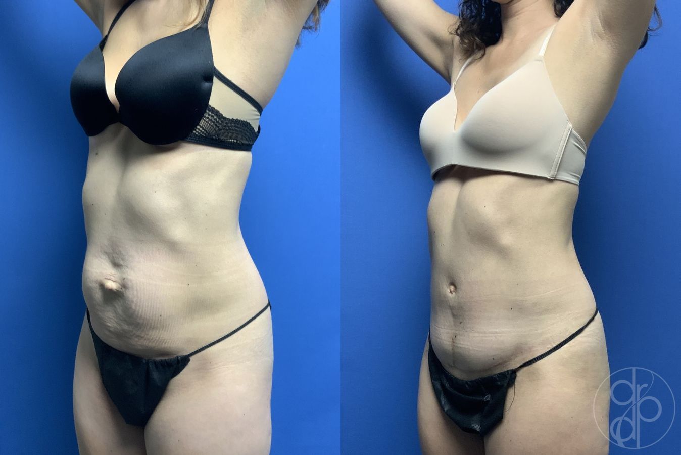 Before and after Abdominoplasty case 29567 - Angle 2