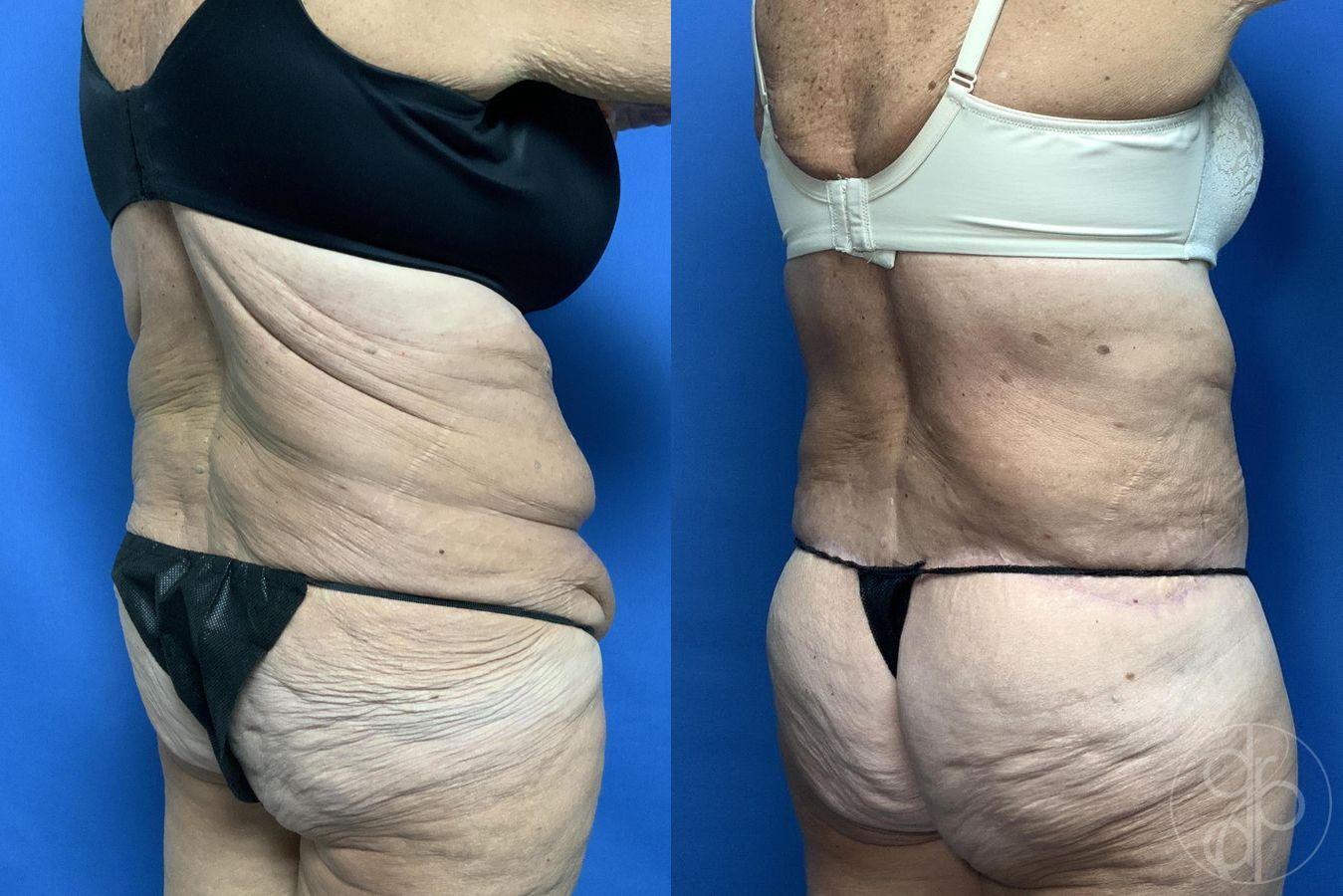Before and after Abdominoplasty case 29620 - Angle 6