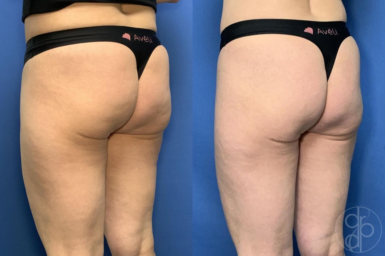 Before and after Avèli case 29537 - Angle 2