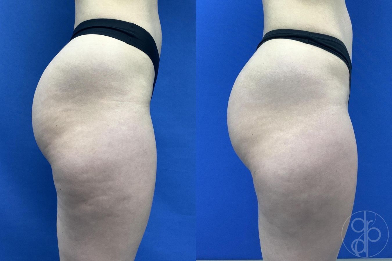Before and after Avèli case 30016 - Angle 5