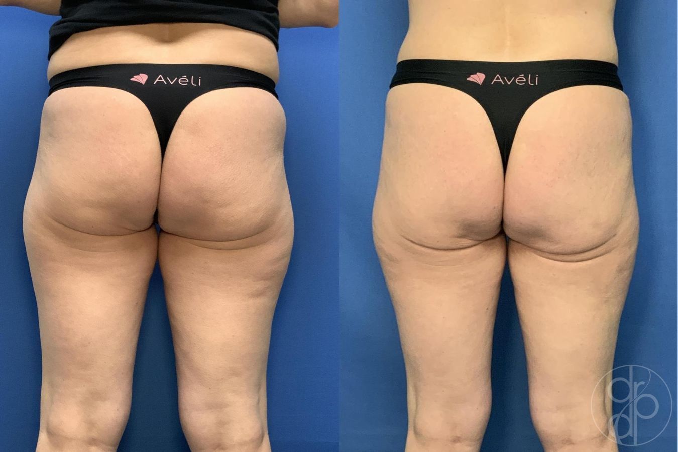 Before and after Avèli case 29537
