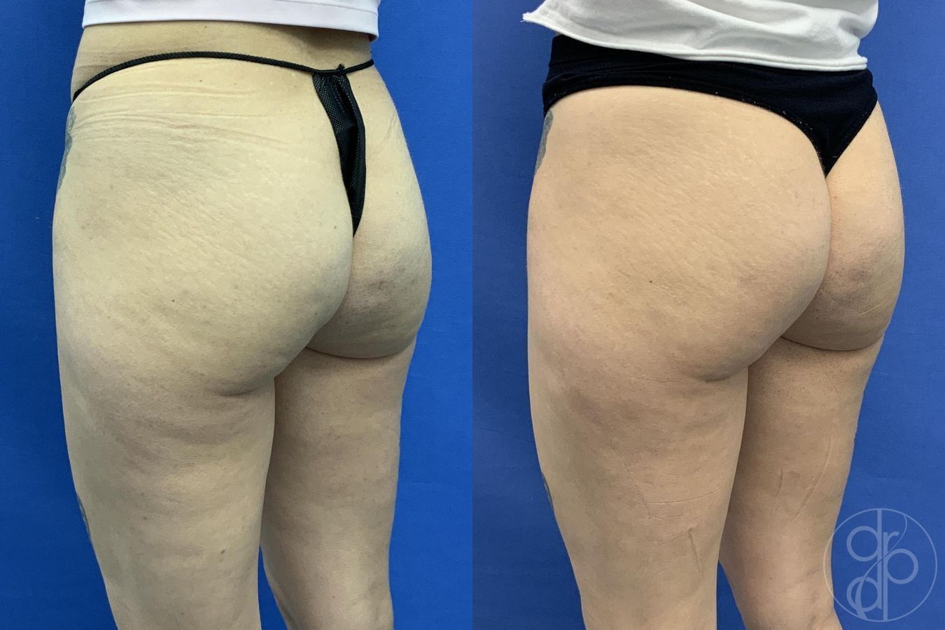 Before and after Avèli case 29615 - Angle 2