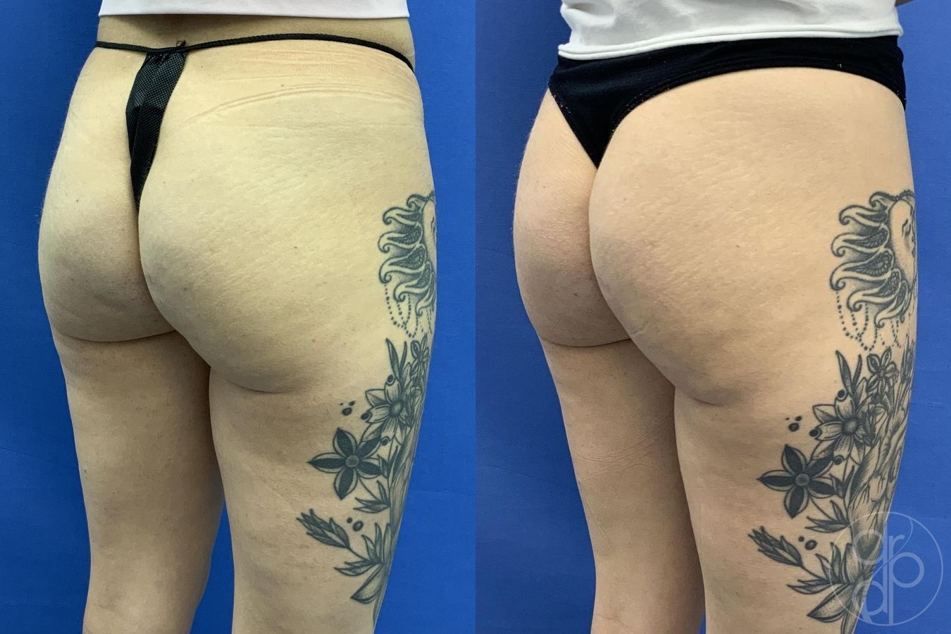 Before and after Avèli case 29615 - Angle 3