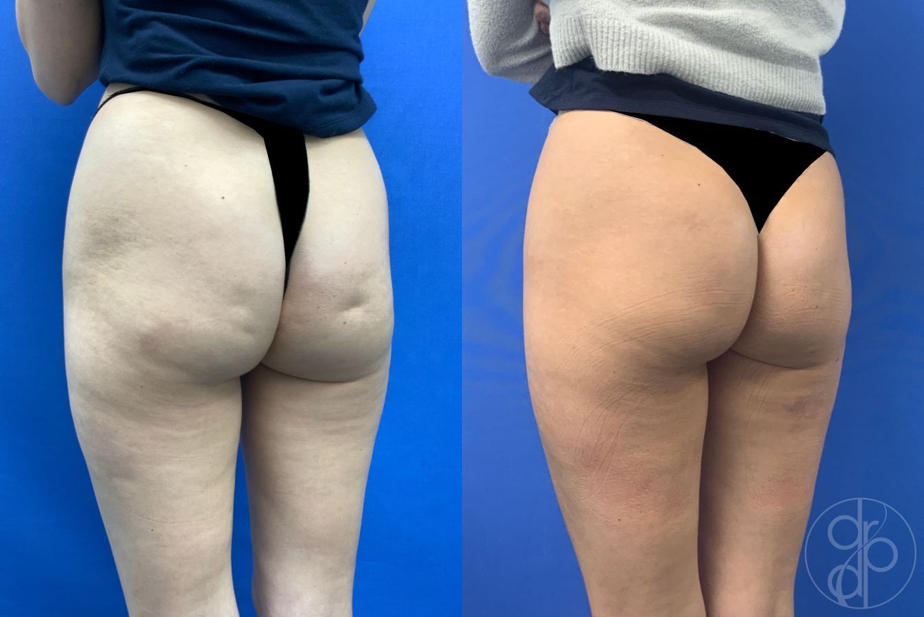 Before and after Avèli case 43153 - Angle 2