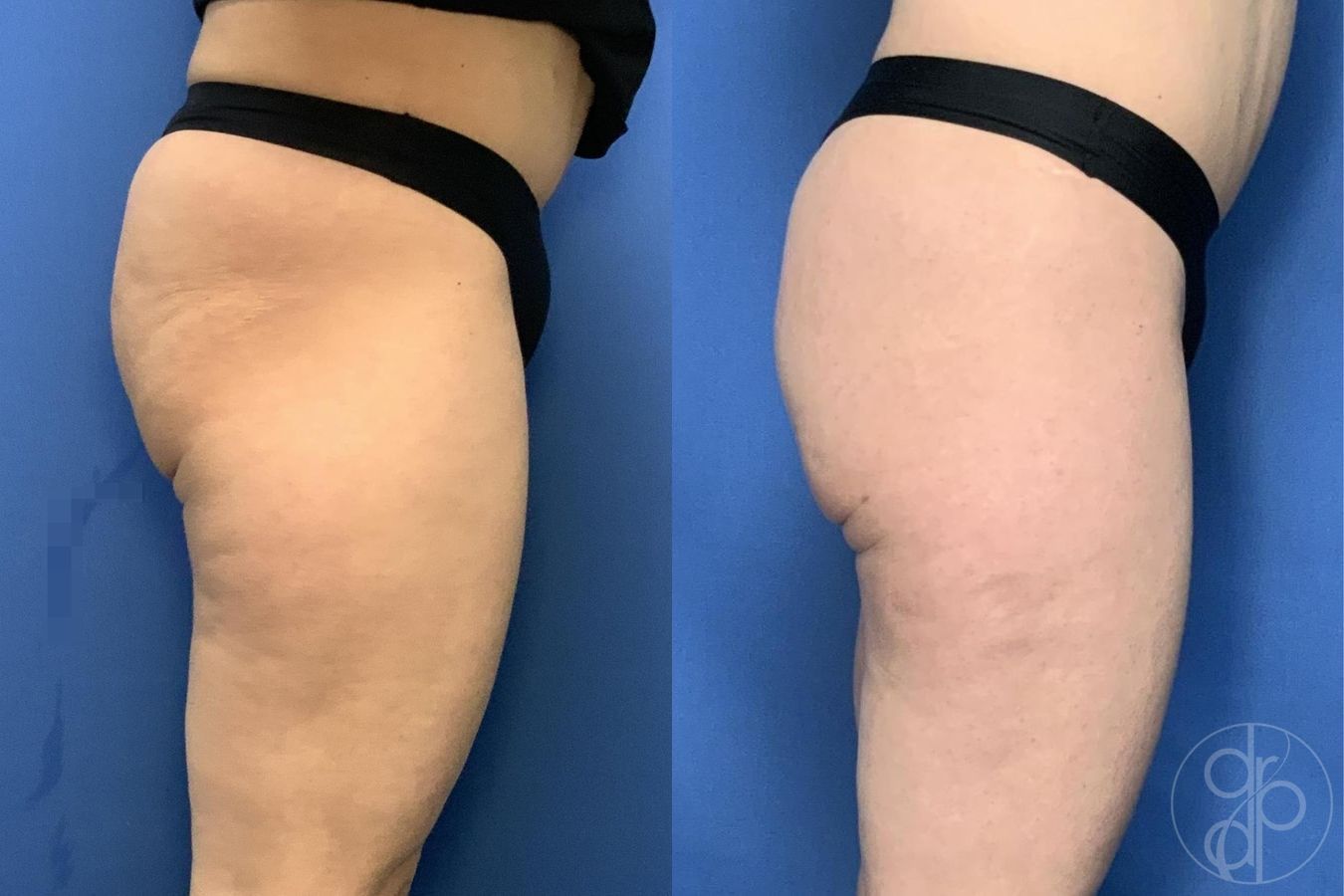 Before and after Avèli case 29537 - Angle 5