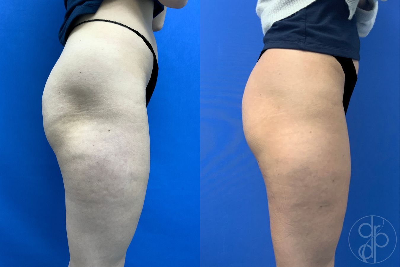 Before and after Avèli case 43153 - Angle 5