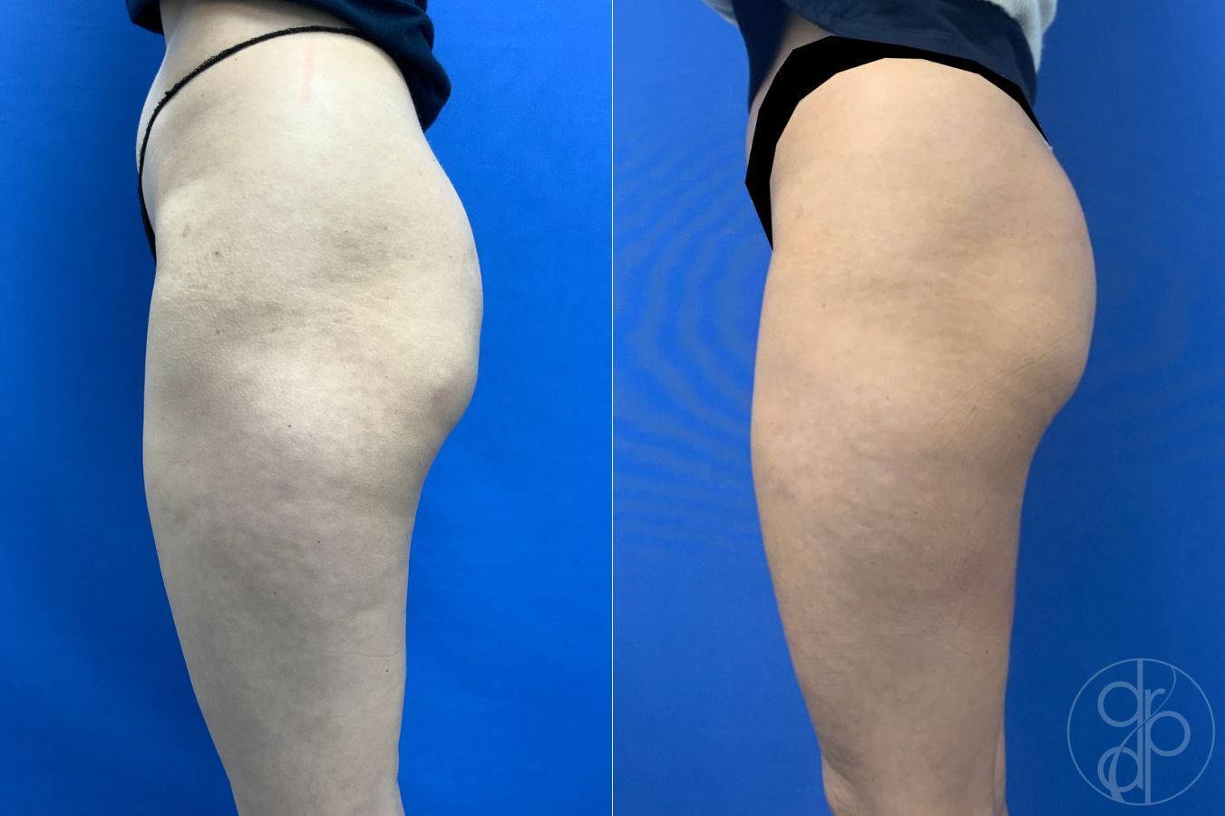 Before and after Avèli case 43153 - Angle 3