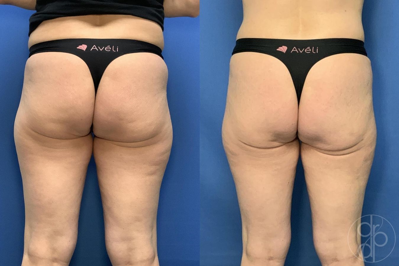 Before and after Avèli case 29537