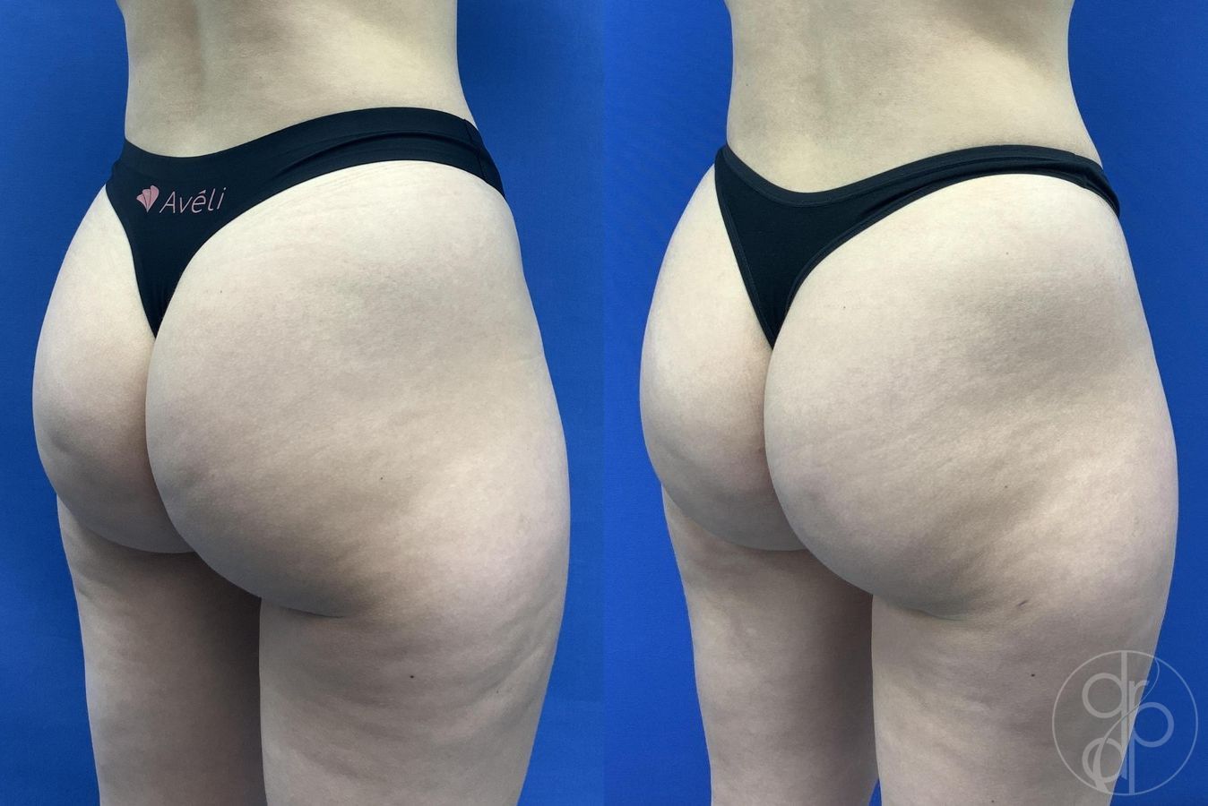 Before and after Avèli case 30016 - Angle 4