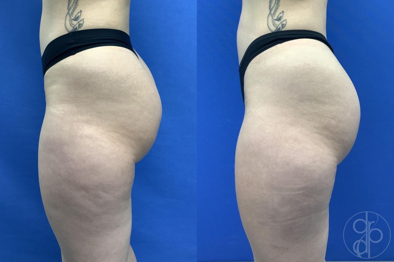 Before and after Avèli case 30016 - Angle 3
