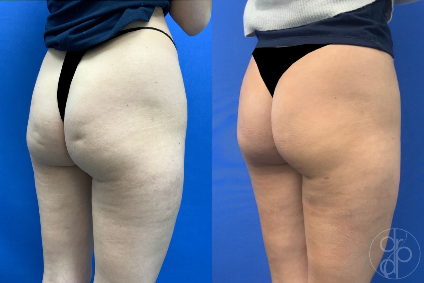Before and after Avèli case 43153 - Angle 4