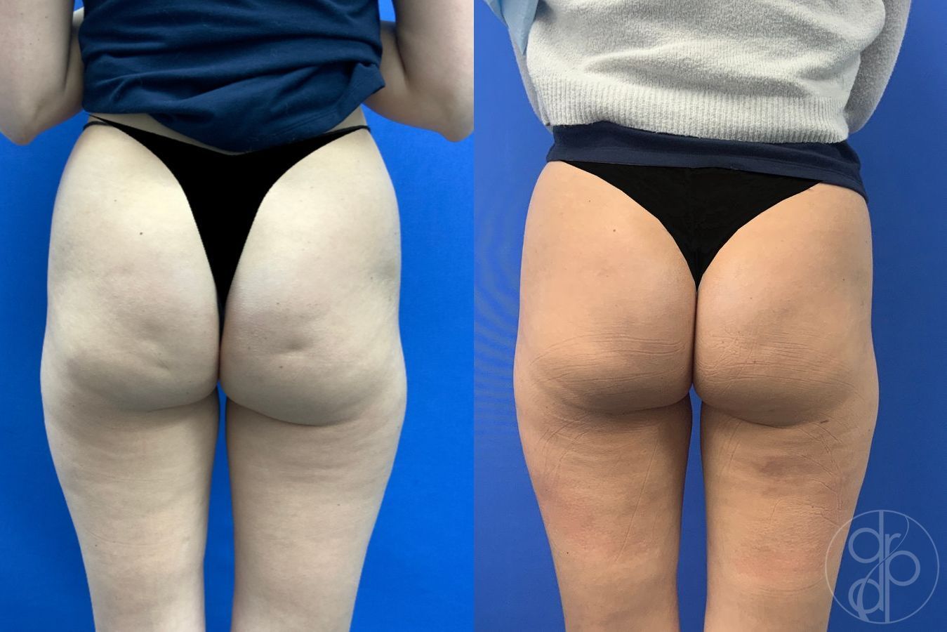Before and after Avèli case 43153