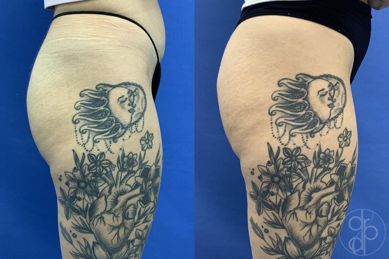 Before and after Avèli case 29615 - Angle 5