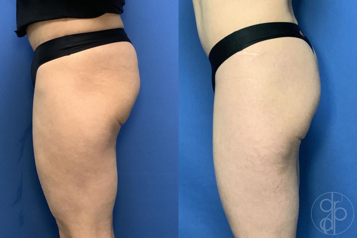 Before and after Avèli case 29537 - Angle 4