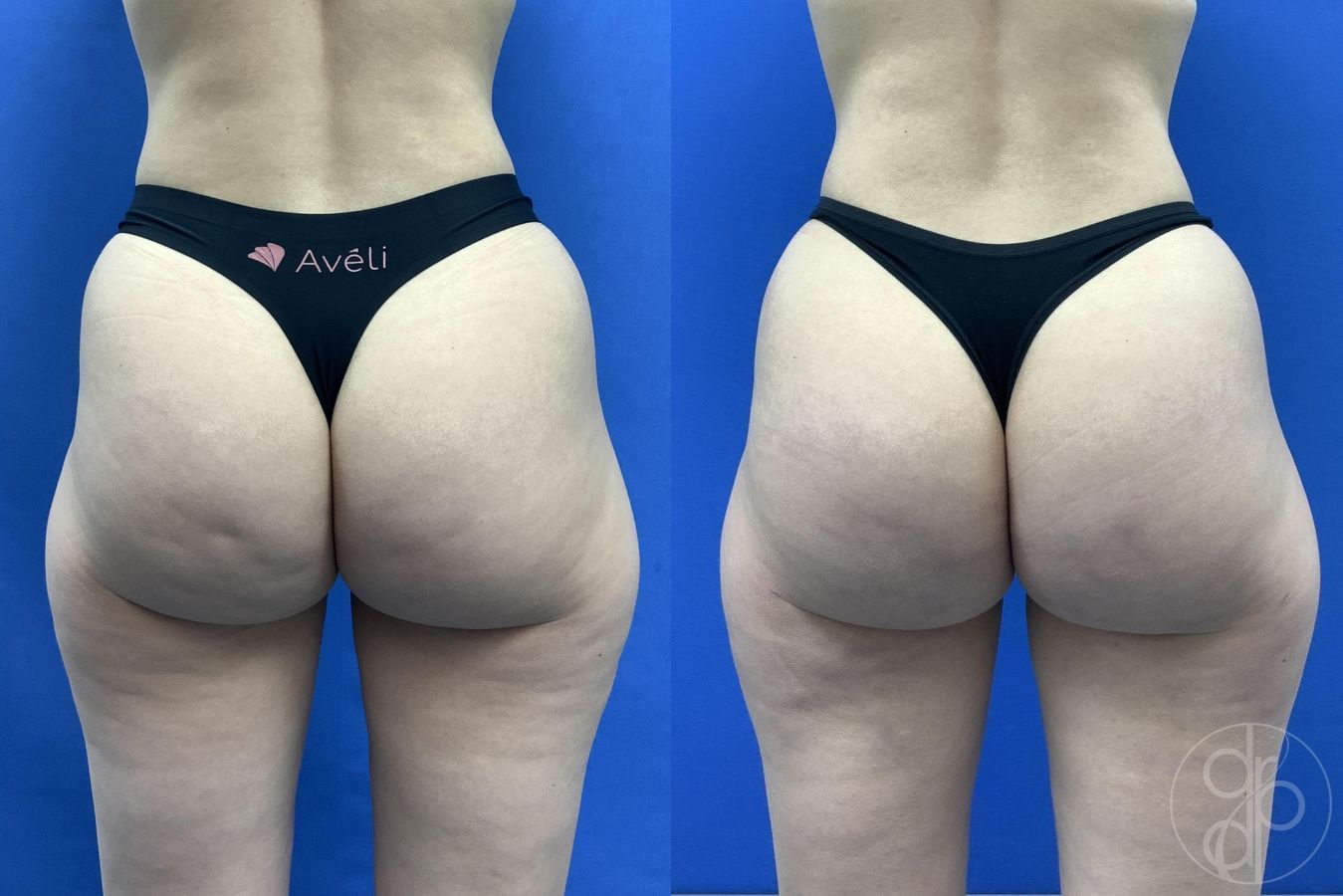 Before and after Avèli case 30016