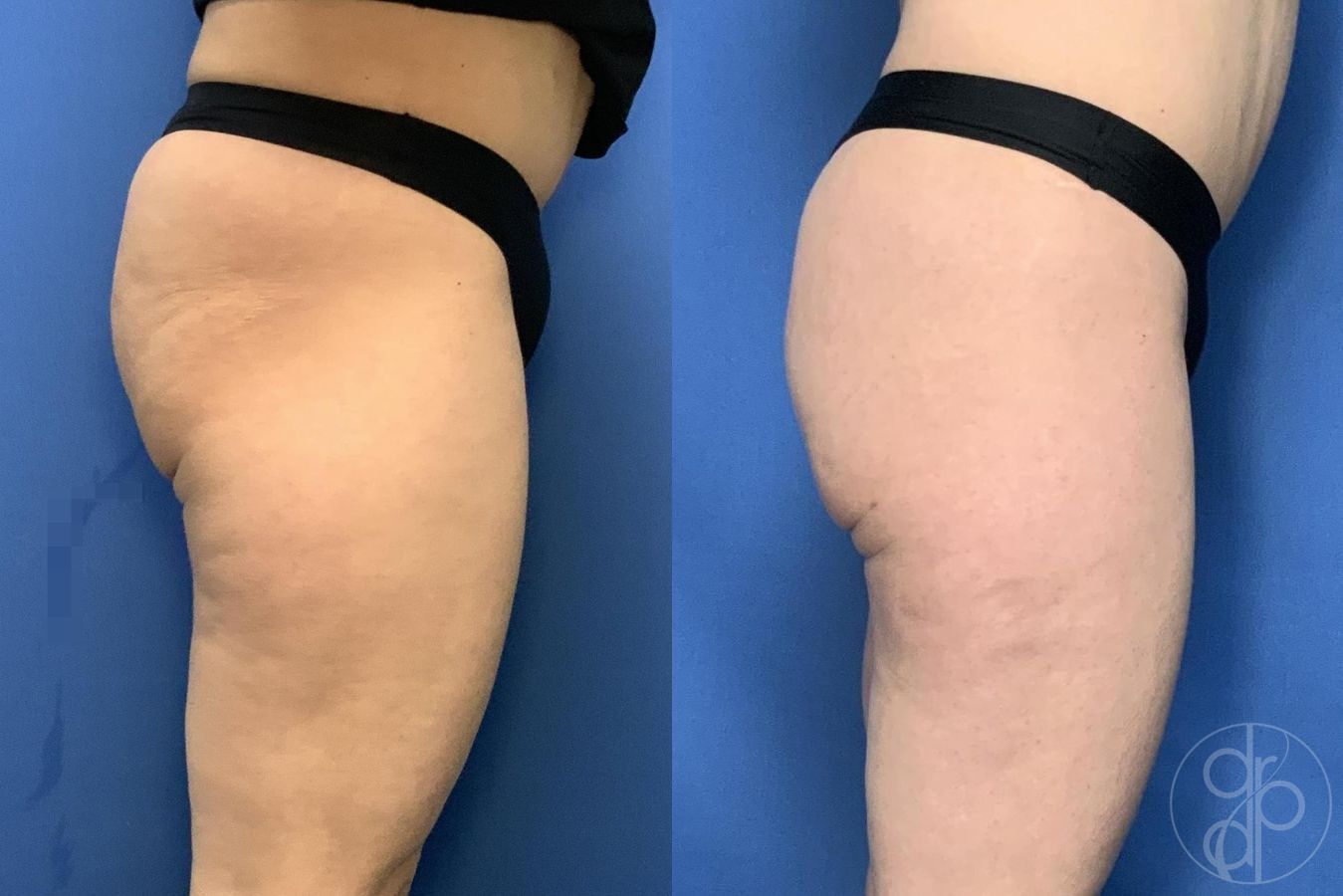 Before and after Avèli case 29537 - Angle 5