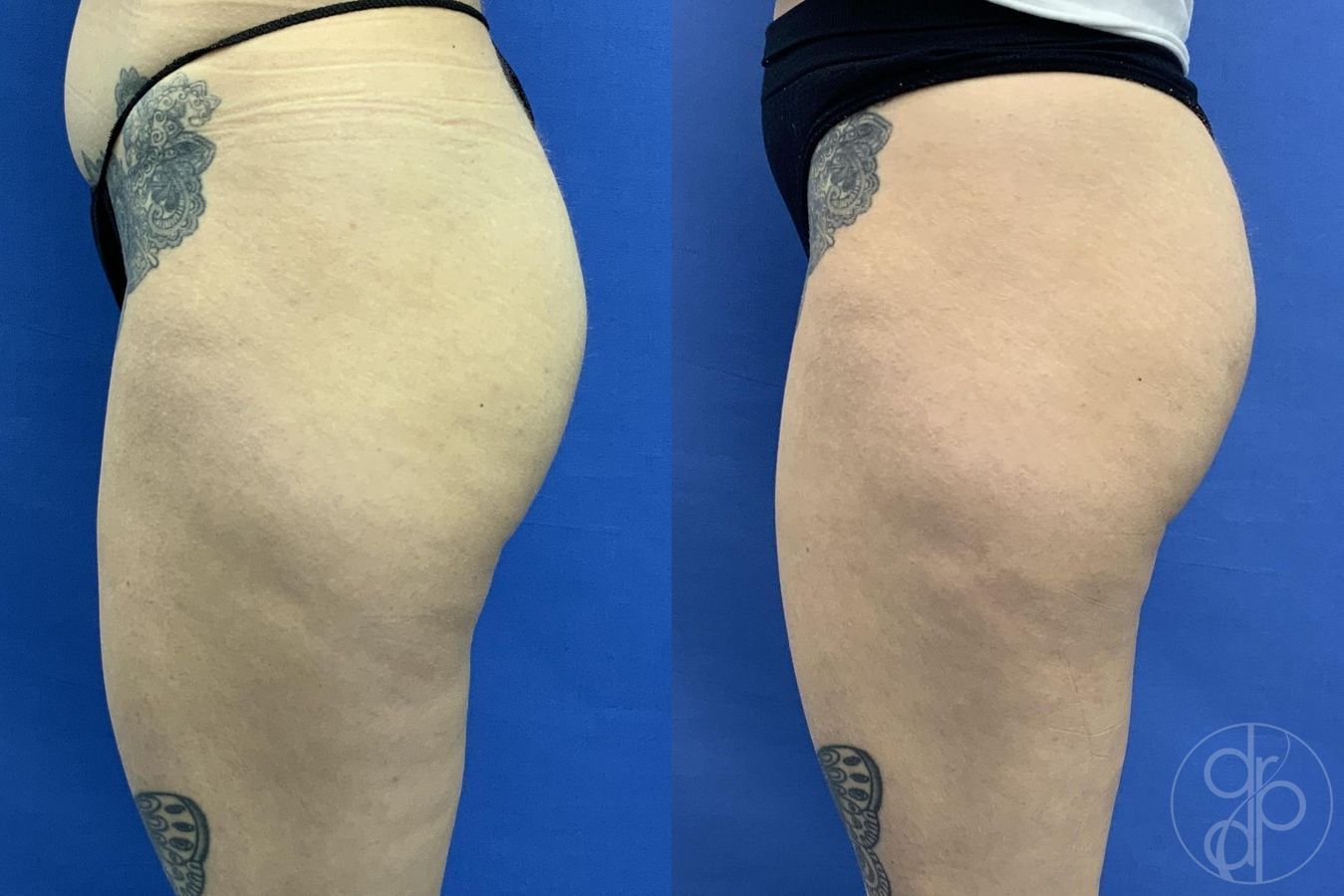 Before and after Avèli case 29615 - Angle 4