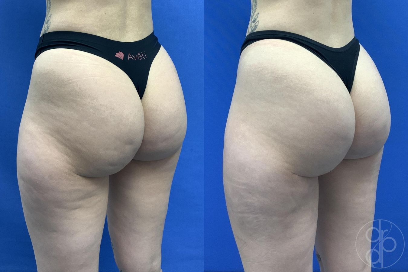 Before and after Avèli case 30016 - Angle 2