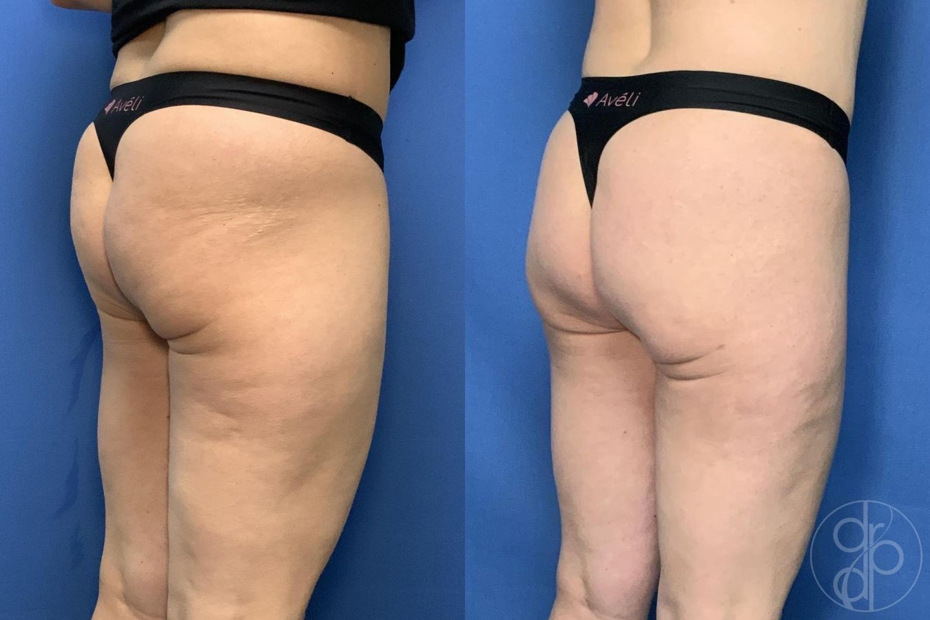 Before and after Avèli case 29537 - Angle 3