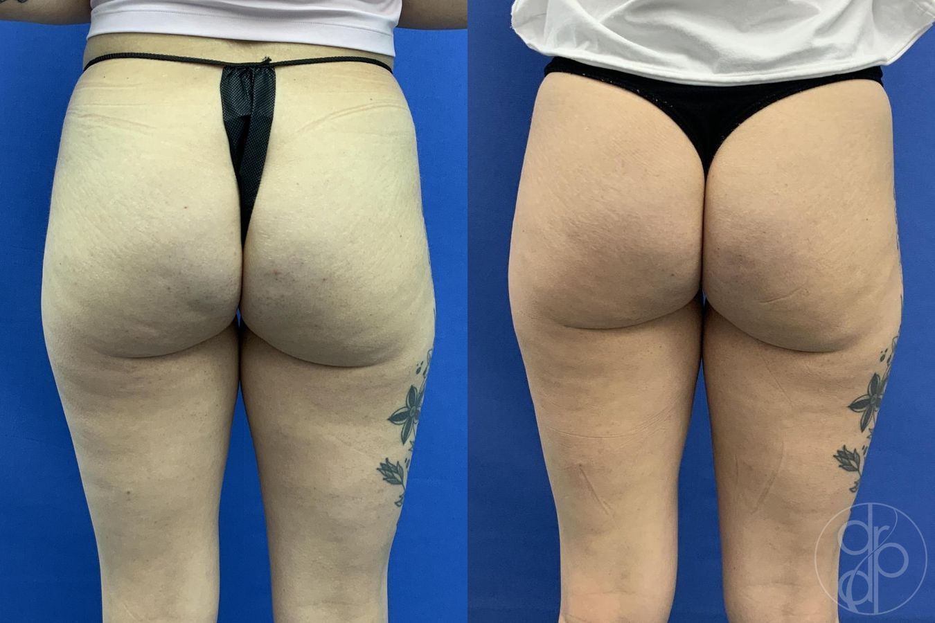 Before and after Avèli case 29615