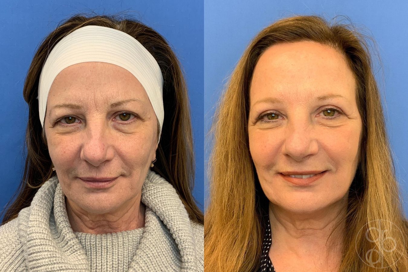 Before and after Blepharoplasty case 29752