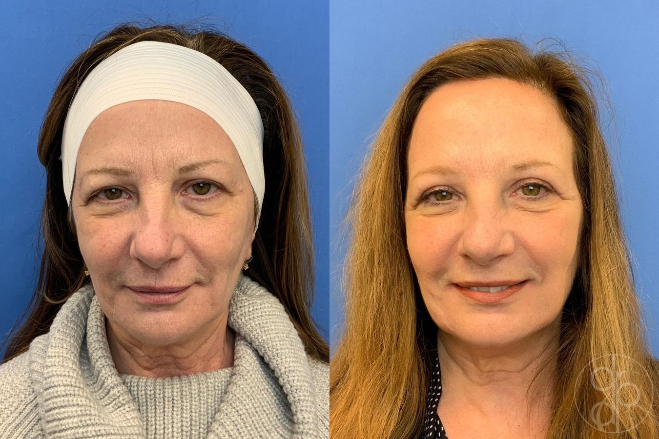 Before and after Blepharoplasty case 29752