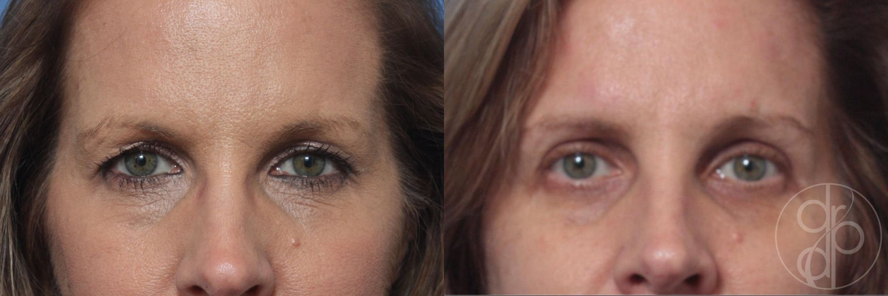 Before and after Blepharoplasty case 29745