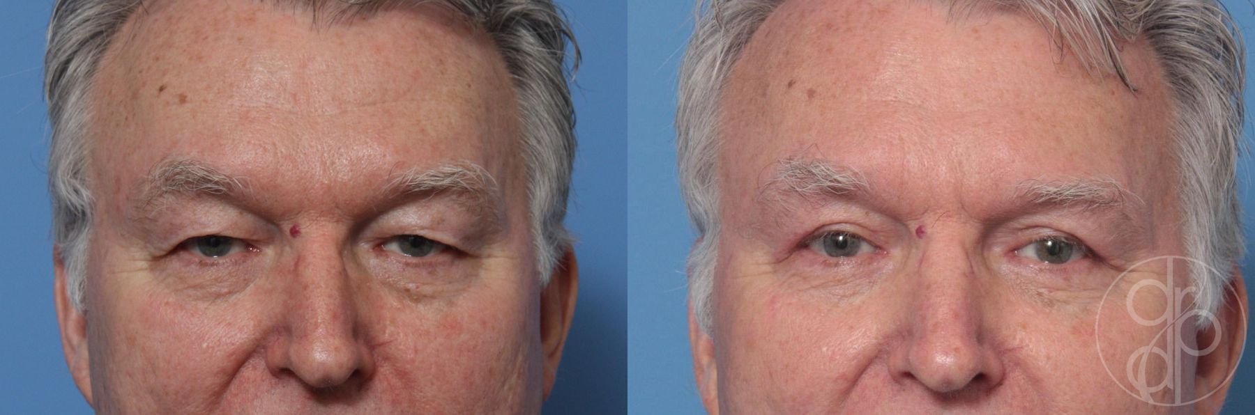 Before and after Blepharoplasty case 29744