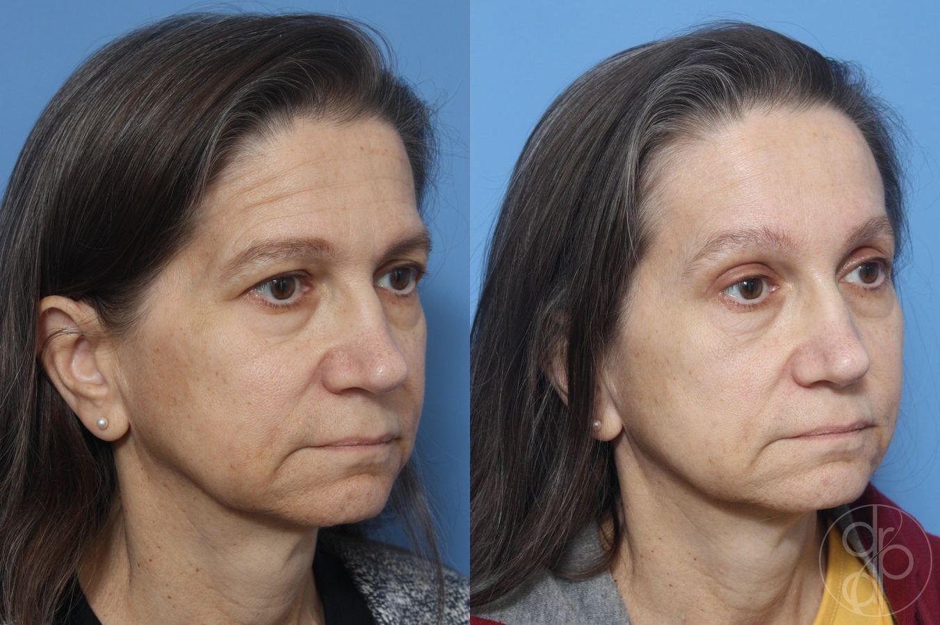 Before and after Blepharoplasty case 29748 - Angle 2