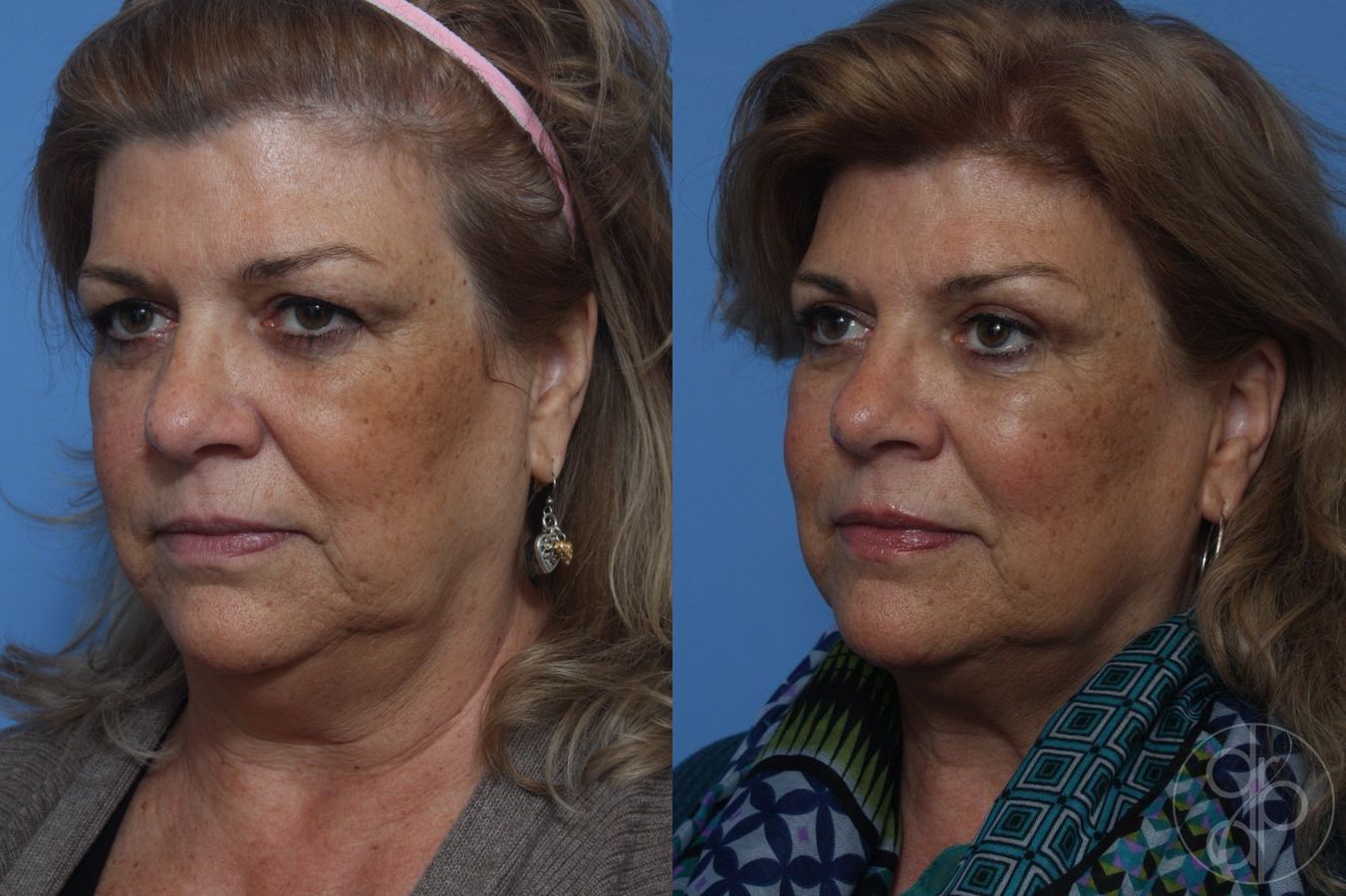 Before and after Blepharoplasty case 29825 - Angle 3
