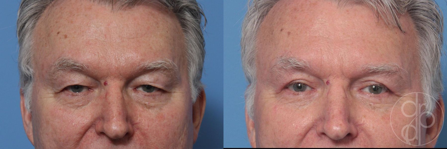 Before and after Blepharoplasty case 29744