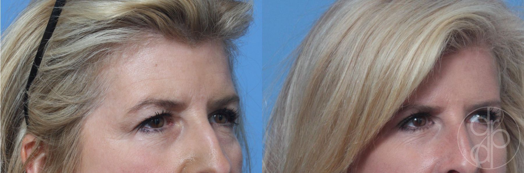 Before and after Blepharoplasty case 29750 - Angle 2