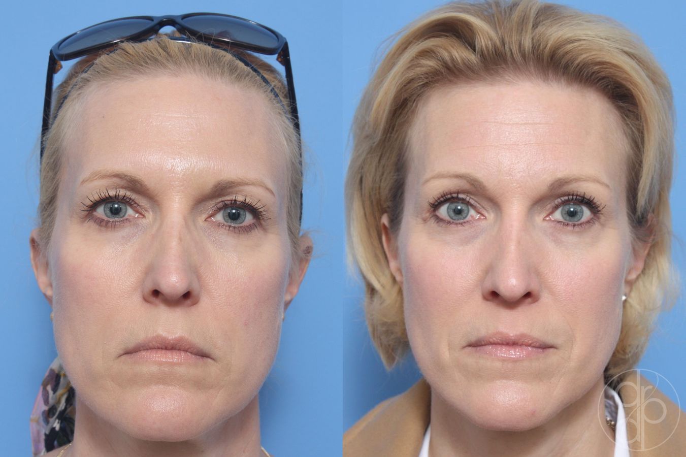 Before and after Blepharoplasty case 29754
