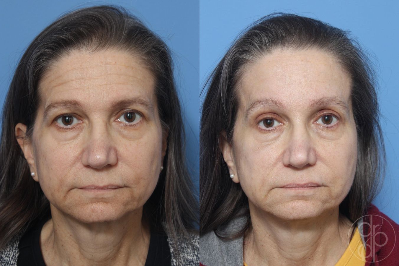 Before and after Blepharoplasty case 29748