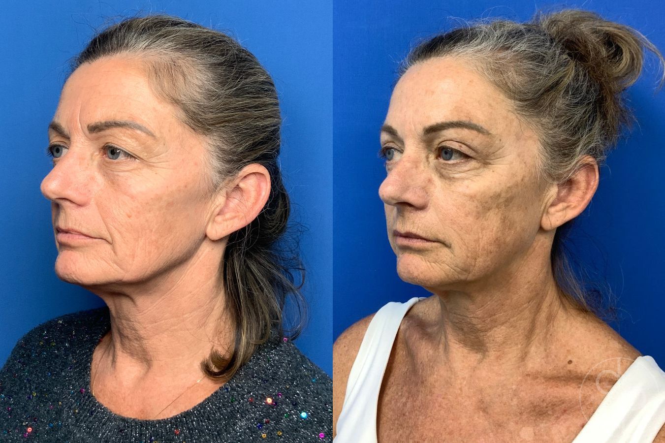 Before and after Blepharoplasty case 46270 - Angle 3