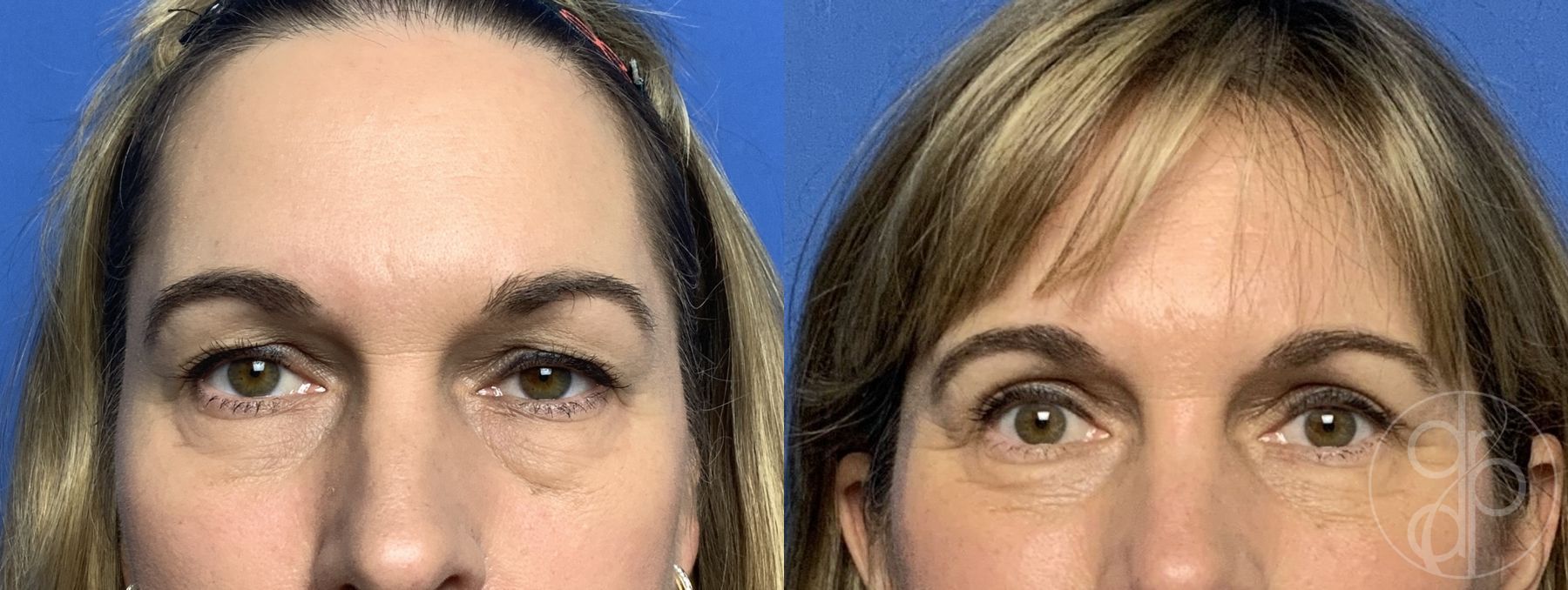 Before and after Blepharoplasty case 29886