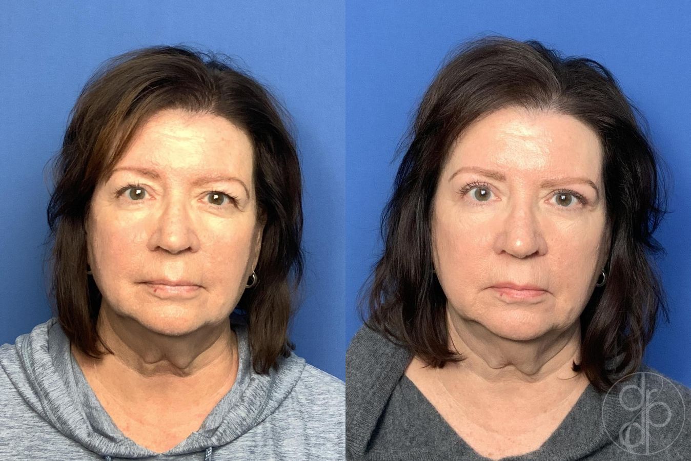 Before and after Blepharoplasty case 30002